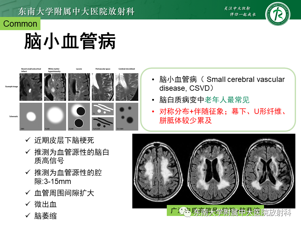 影像PPT - 【PPT】成人脑白质受累为主的弥漫/融合分布病变的诊断思路-31
