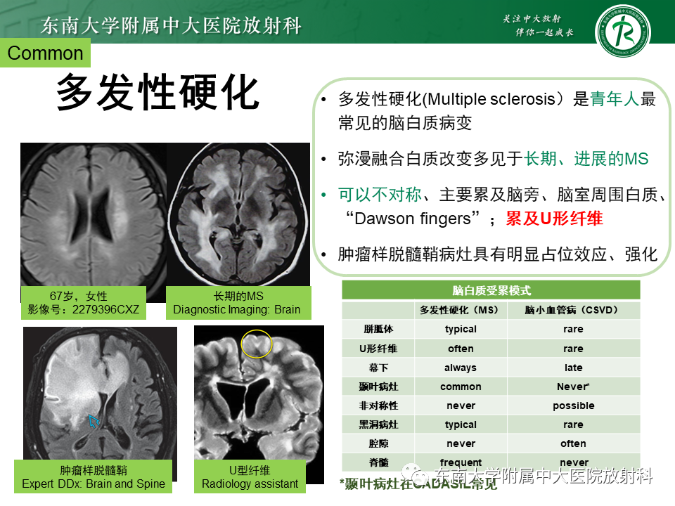 影像PPT - 【PPT】成人脑白质受累为主的弥漫/融合分布病变的诊断思路-32