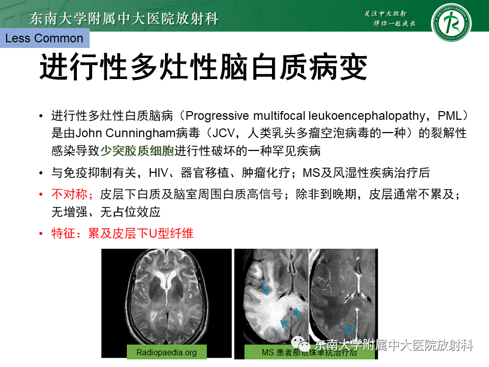 影像PPT - 【PPT】成人脑白质受累为主的弥漫/融合分布病变的诊断思路-40