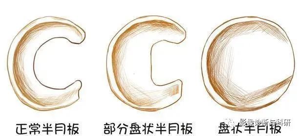 影像PPT - 盘状半月板及撕裂-1 影像PPT - 盘状半月板及撕裂-1