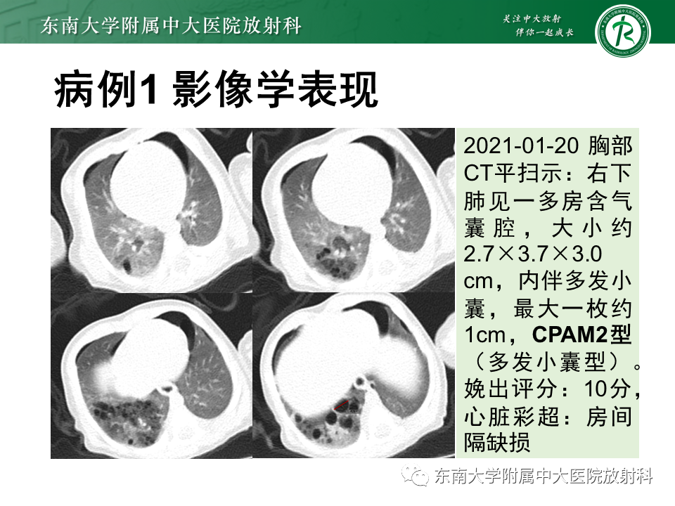 影像PPT - 【PPT】先天性肺气道畸形（CPAM）-2