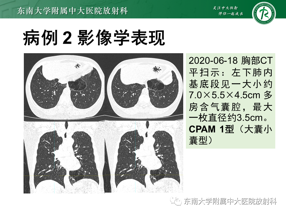 影像PPT - 【PPT】先天性肺气道畸形（CPAM）-12