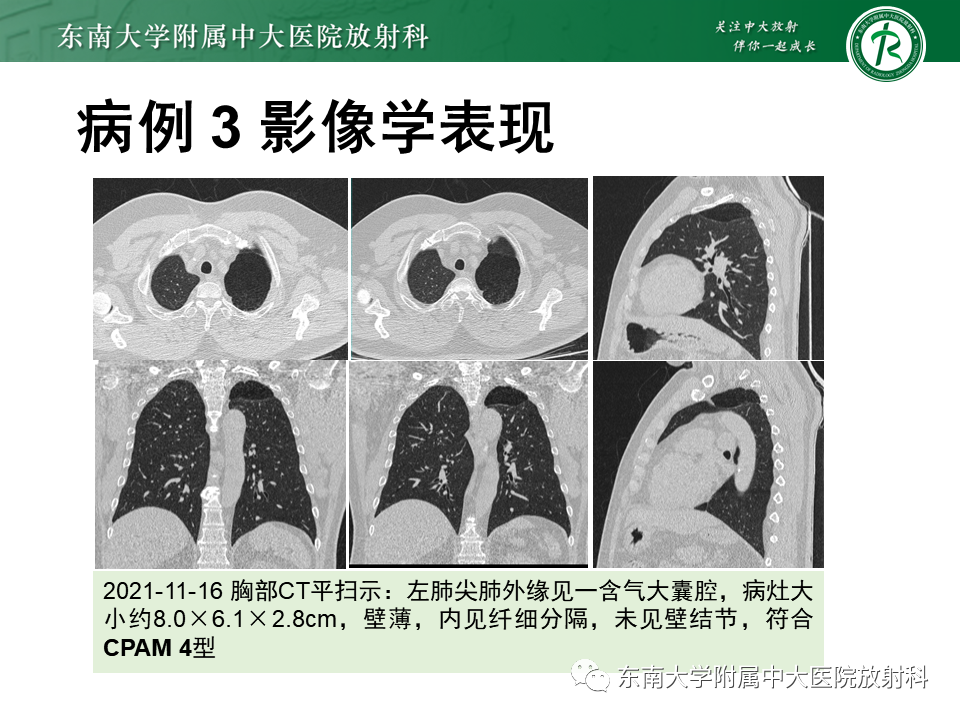 影像PPT - 【PPT】先天性肺气道畸形（CPAM）-14