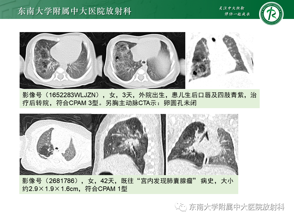 影像PPT - 【PPT】先天性肺气道畸形（CPAM）-15