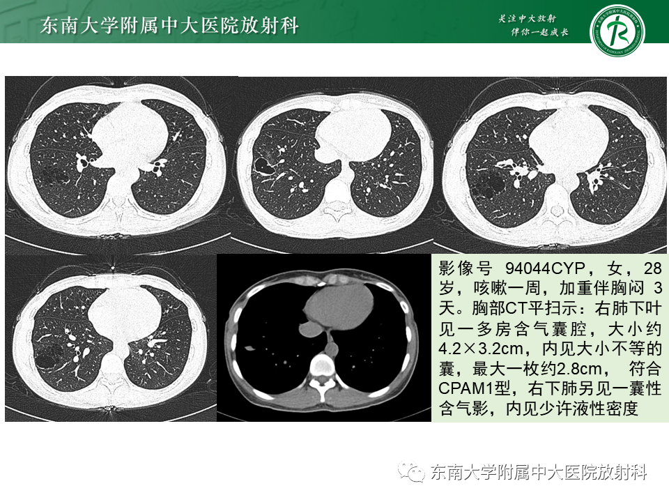 影像PPT - 【PPT】先天性肺气道畸形（CPAM）-16