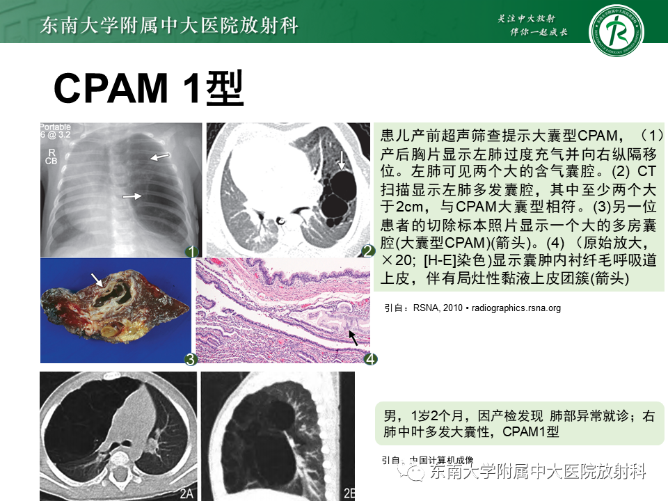 影像PPT - 【PPT】先天性肺气道畸形（CPAM）-17