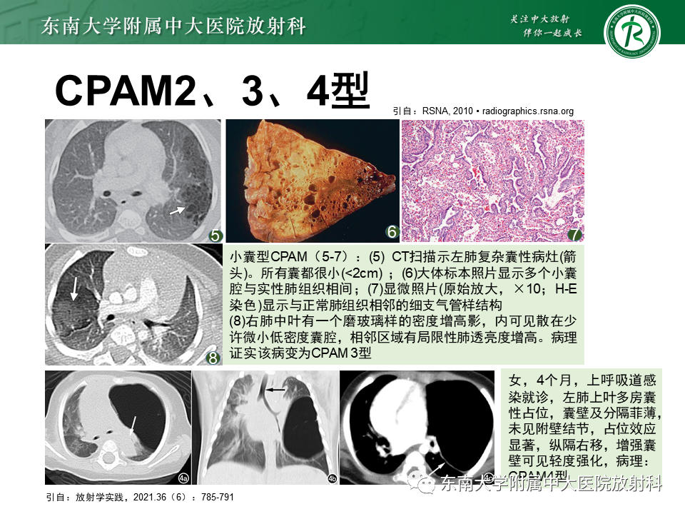 影像PPT - 【PPT】先天性肺气道畸形（CPAM）-18