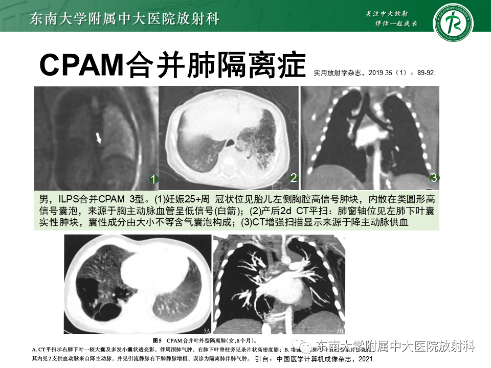 影像PPT - 【PPT】先天性肺气道畸形（CPAM）-19