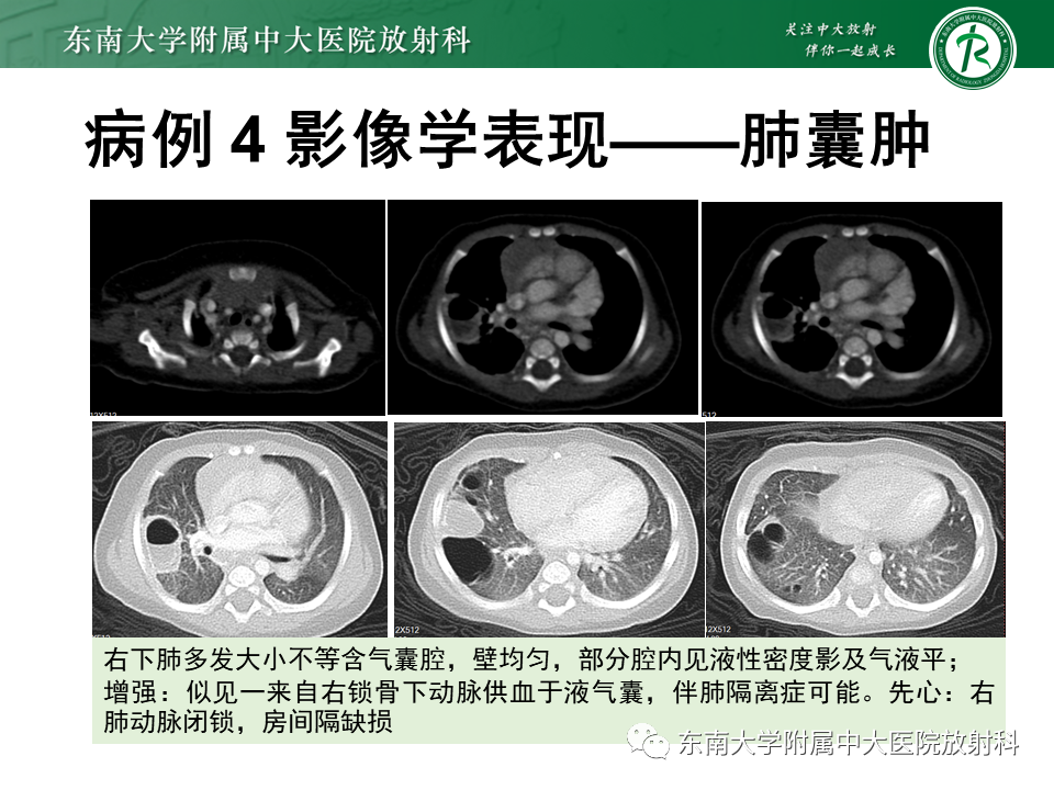 影像PPT - 【PPT】先天性肺气道畸形（CPAM）-22