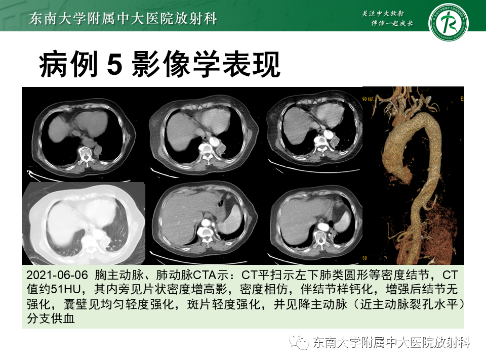 影像PPT - 【PPT】先天性肺气道畸形（CPAM）-26