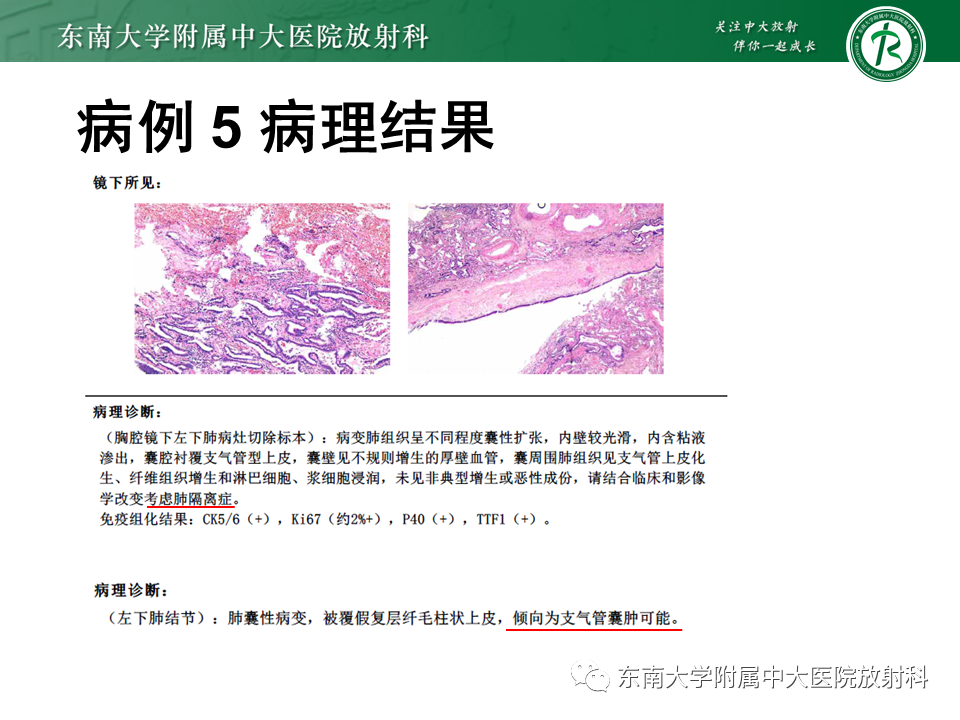 影像PPT - 【PPT】先天性肺气道畸形（CPAM）-27
