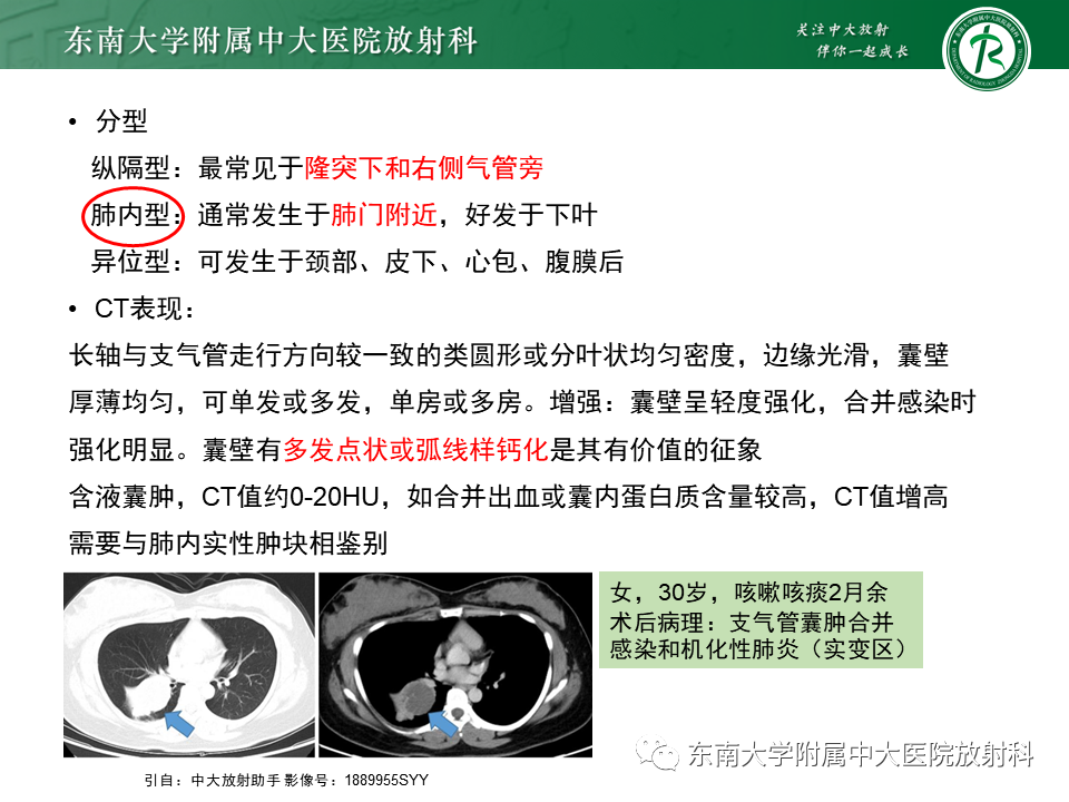 影像PPT - 【PPT】先天性肺气道畸形（CPAM）-29