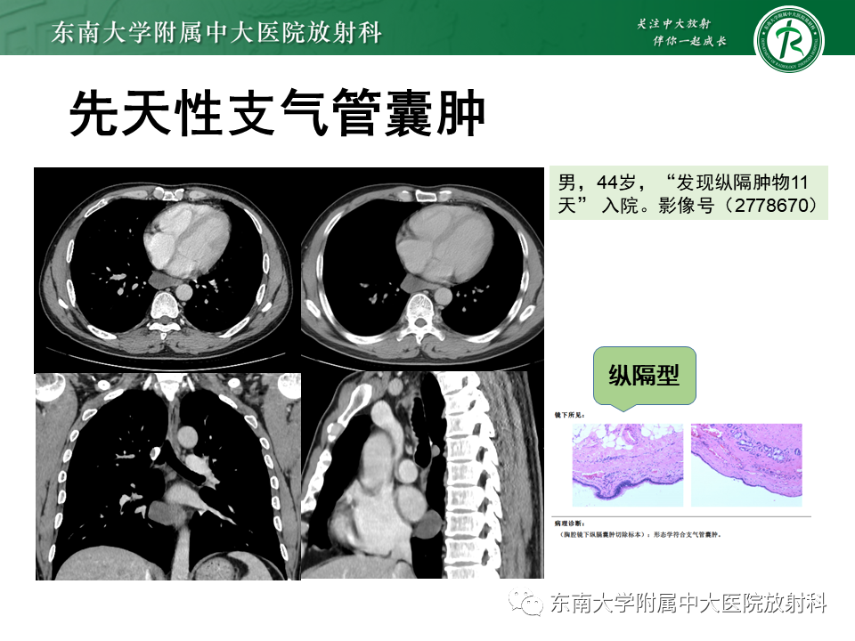 影像PPT - 【PPT】先天性肺气道畸形（CPAM）-30