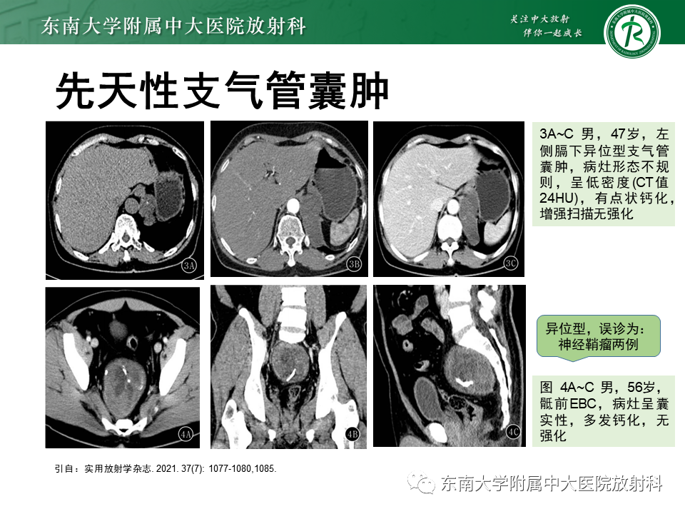 影像PPT - 【PPT】先天性肺气道畸形（CPAM）-31
