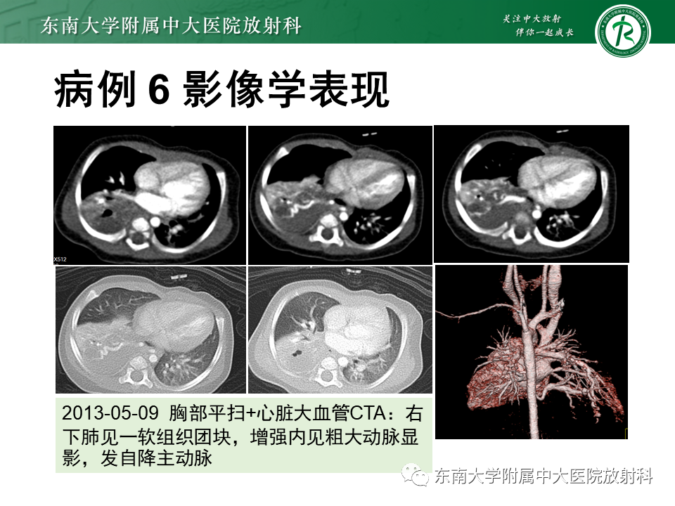 影像PPT - 【PPT】先天性肺气道畸形（CPAM）-34