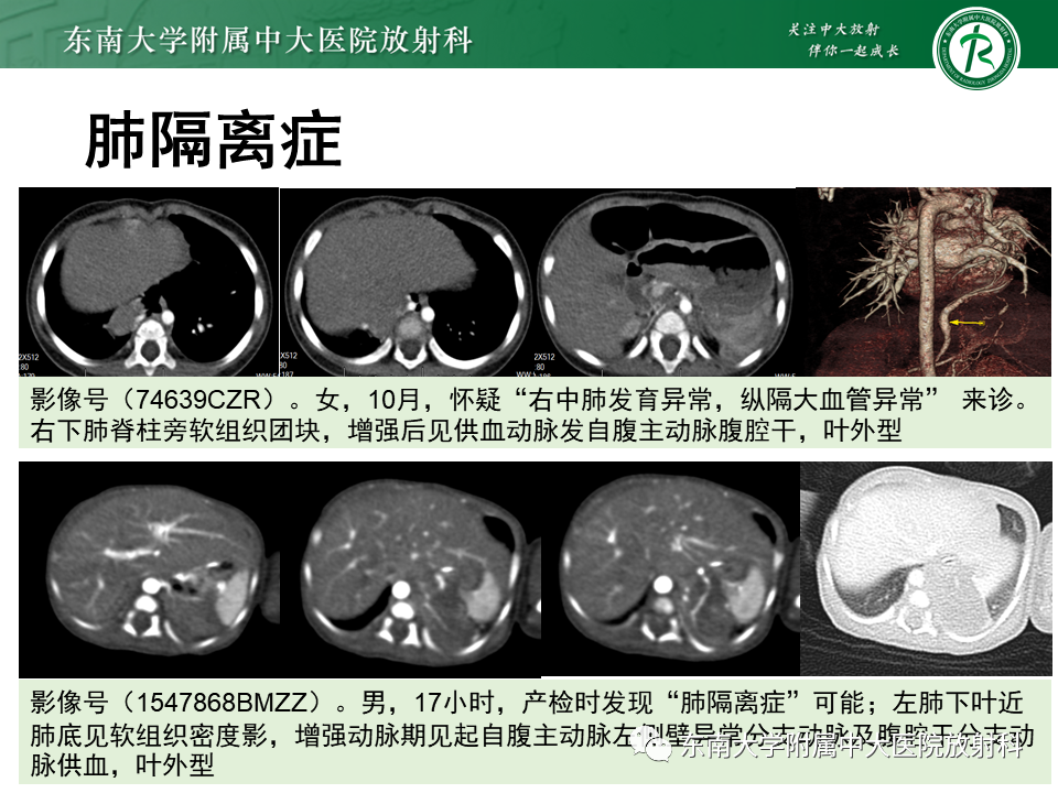 影像PPT - 【PPT】先天性肺气道畸形（CPAM）-36