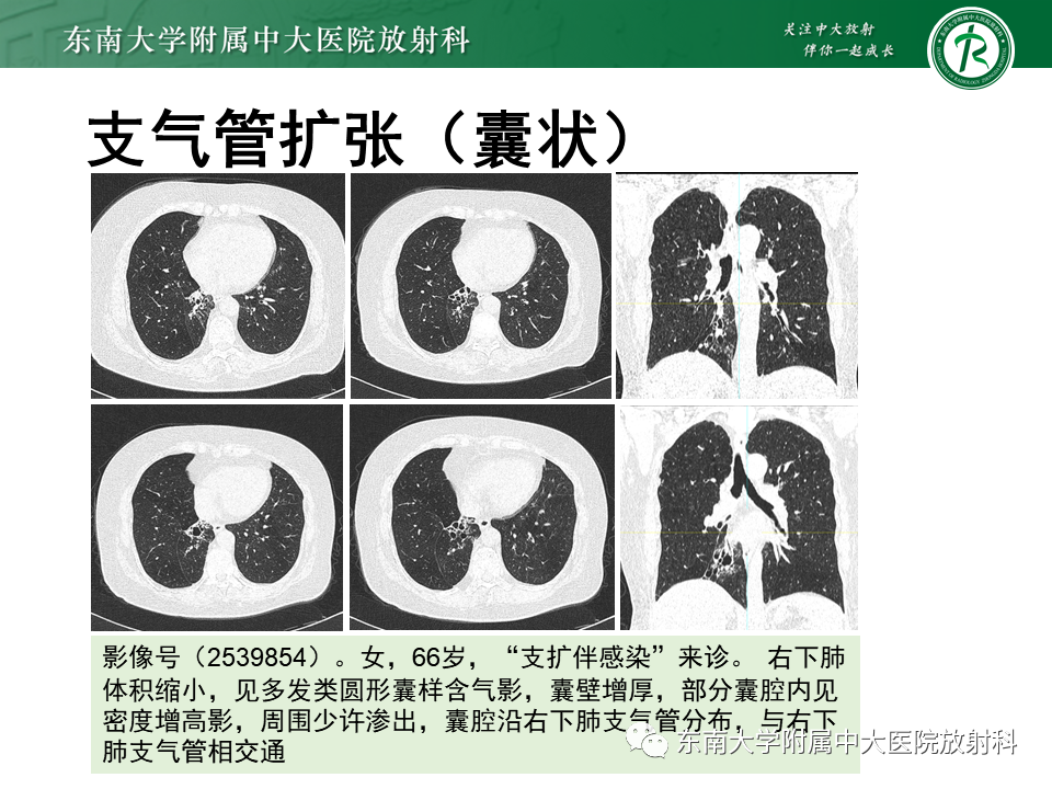 影像PPT - 【PPT】先天性肺气道畸形（CPAM）-37