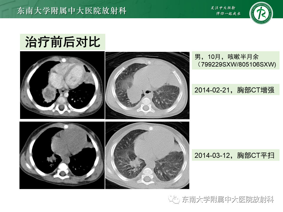 影像PPT - 【PPT】先天性肺气道畸形（CPAM）-38