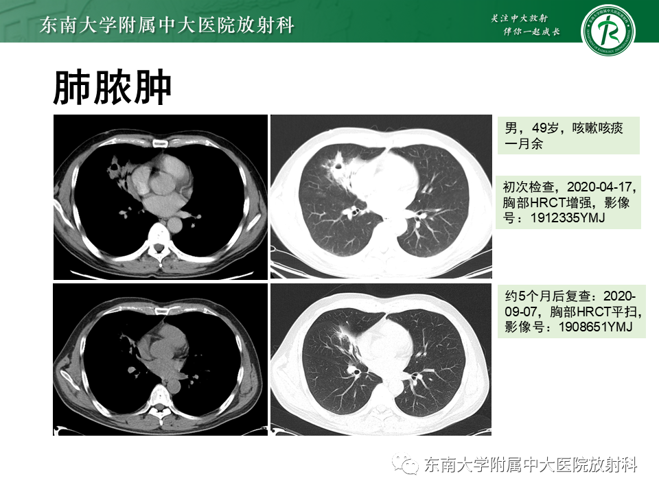 影像PPT - 【PPT】先天性肺气道畸形（CPAM）-40