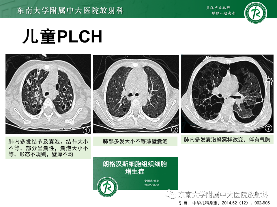 影像PPT - 【PPT】先天性肺气道畸形（CPAM）-42