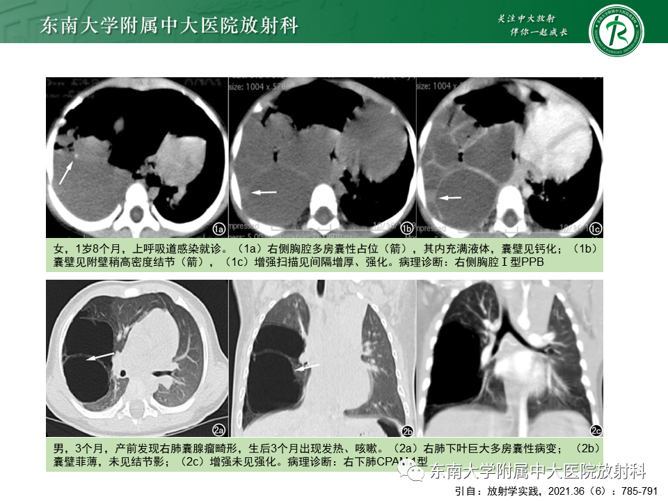 影像PPT - 【PPT】先天性肺气道畸形（CPAM）-46