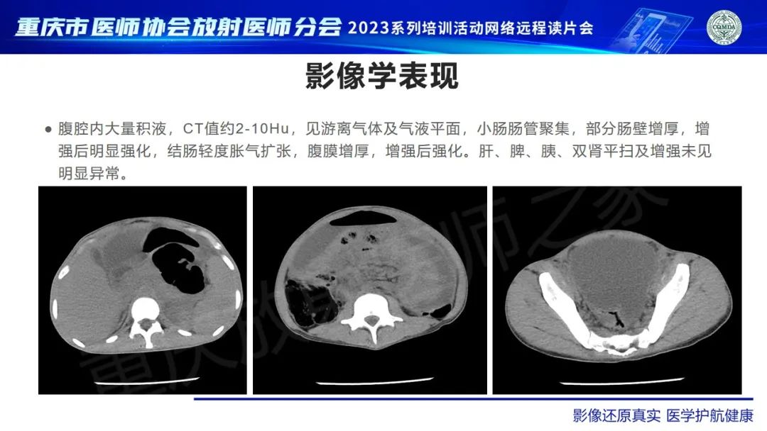 影像PPT - 【病例】腹腔结核/结核性腹膜炎1例CT影像-3