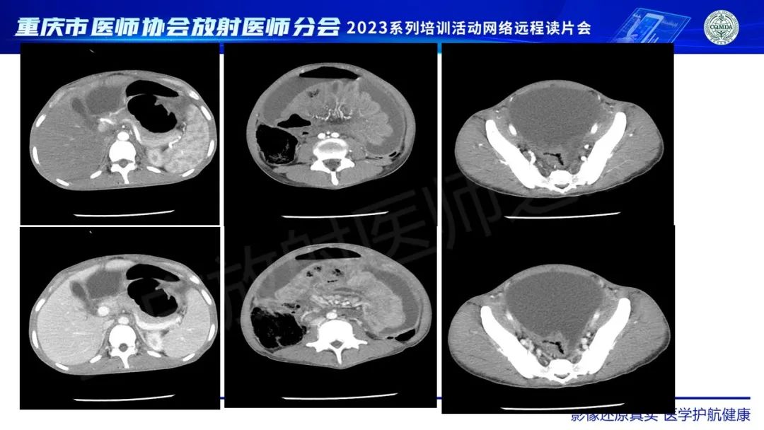 影像PPT - 【病例】腹腔结核/结核性腹膜炎1例CT影像-4