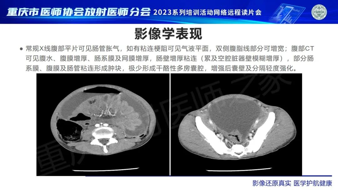 影像PPT - 【病例】腹腔结核/结核性腹膜炎1例CT影像-8