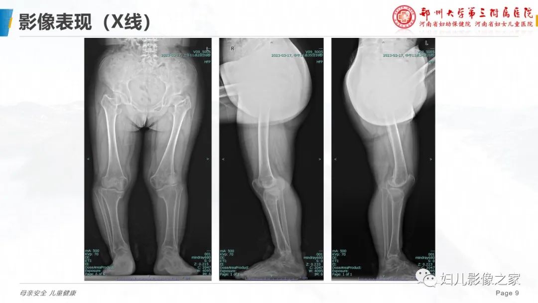 影像PPT - 【PPT】假性甲状旁腺功能减退症-9