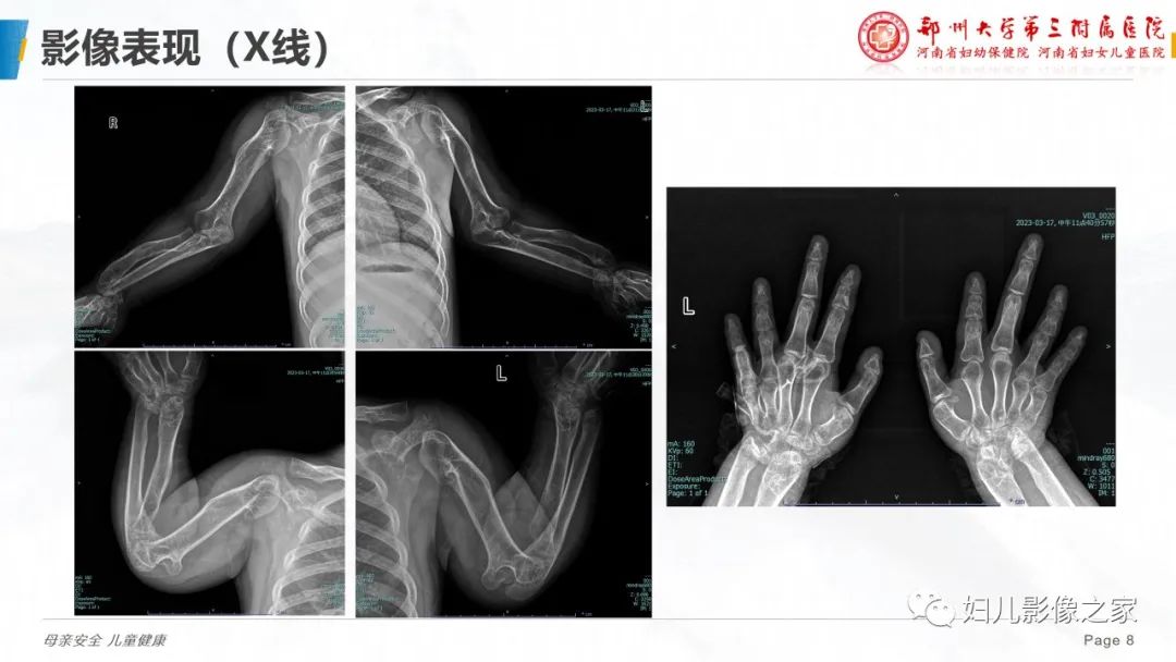 影像PPT - 【PPT】假性甲状旁腺功能减退症-8