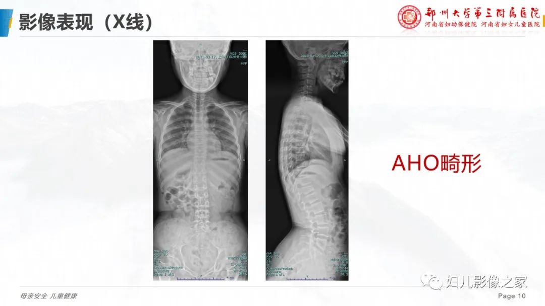 影像PPT - 【PPT】假性甲状旁腺功能减退症-10