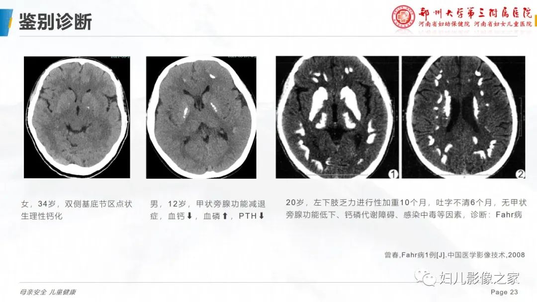 影像PPT - 【PPT】假性甲状旁腺功能减退症-23