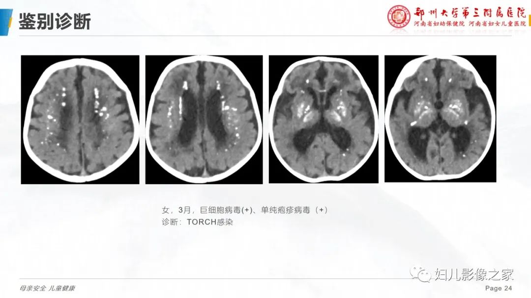 影像PPT - 【PPT】假性甲状旁腺功能减退症-24