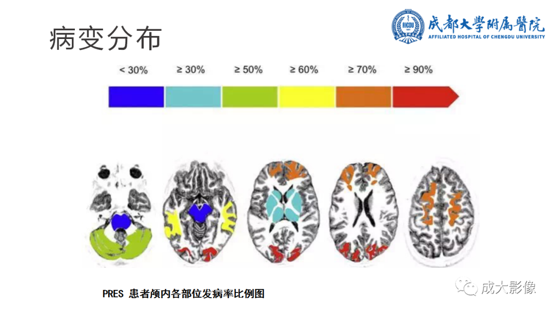 影像PPT - 【PPT】可逆性后部脑病综合征-7