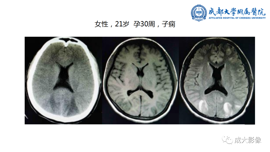 影像PPT - 【PPT】可逆性后部脑病综合征-10
