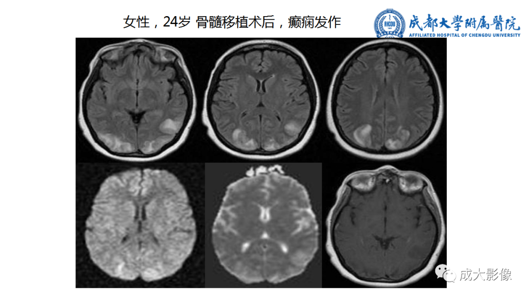影像PPT - 【PPT】可逆性后部脑病综合征-11