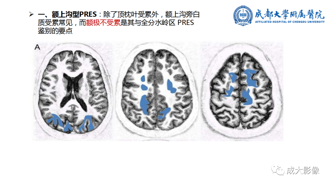 影像PPT - 【PPT】可逆性后部脑病综合征-15