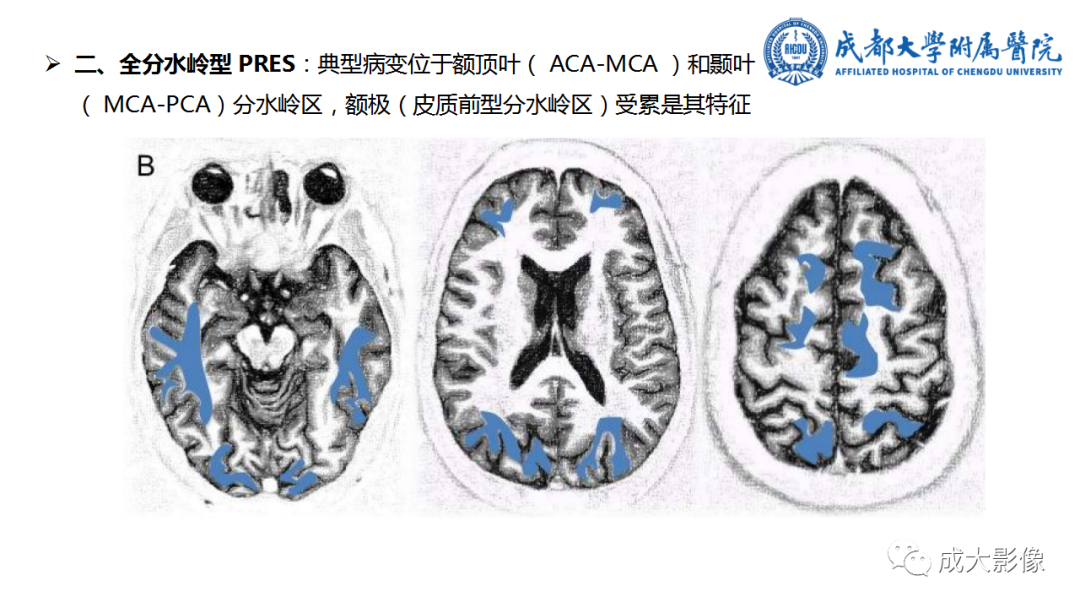 影像PPT - 【PPT】可逆性后部脑病综合征-16