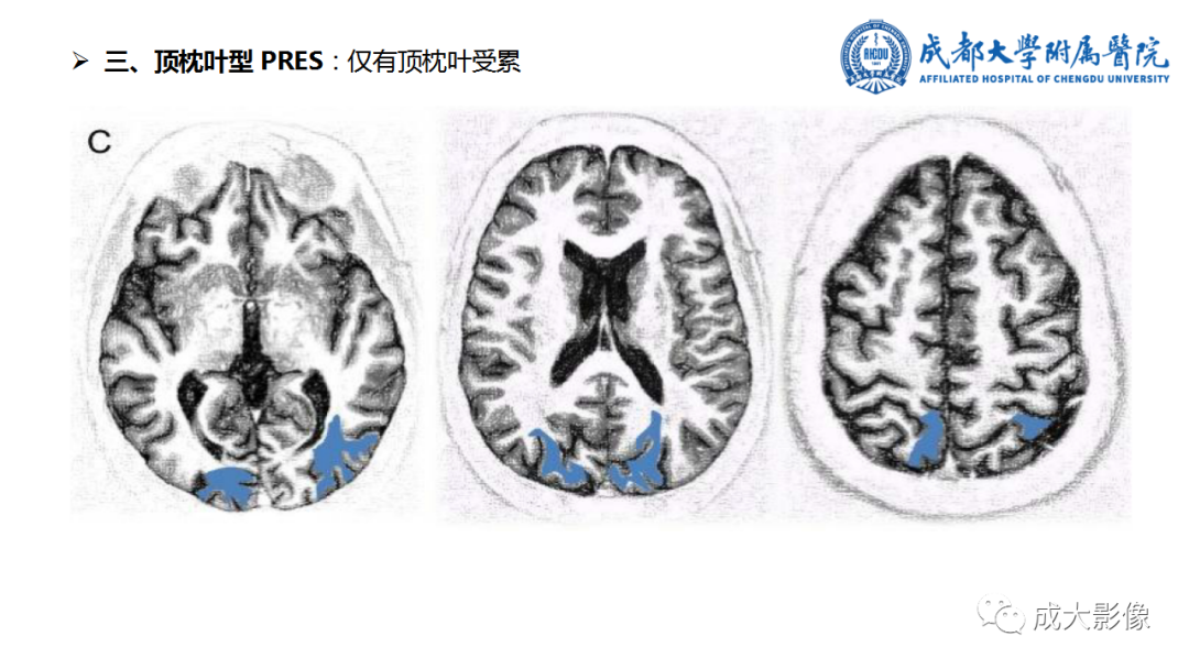 影像PPT - 【PPT】可逆性后部脑病综合征-17