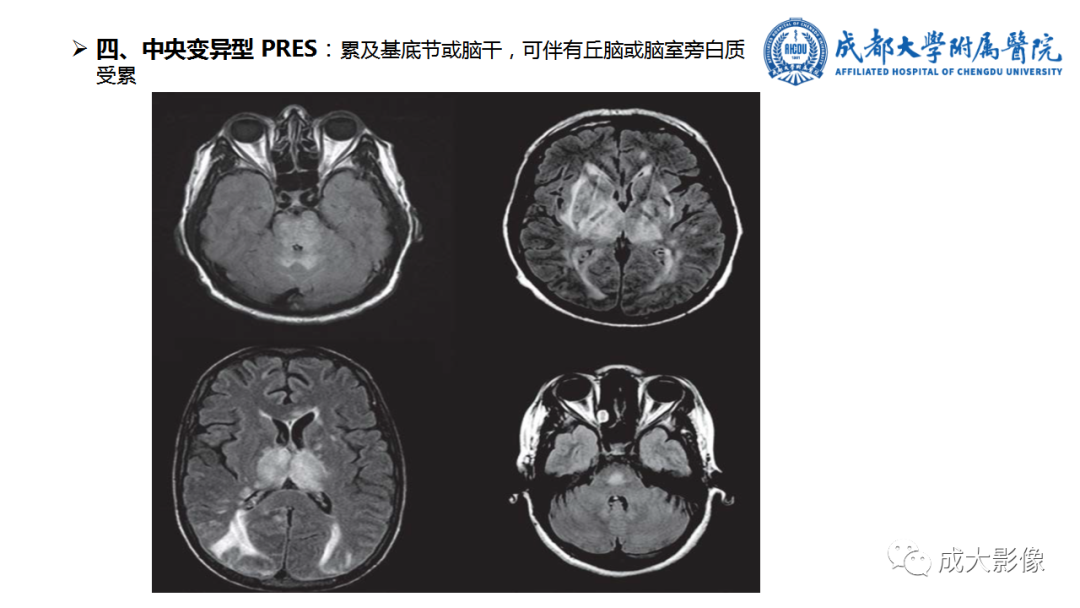 影像PPT - 【PPT】可逆性后部脑病综合征-18