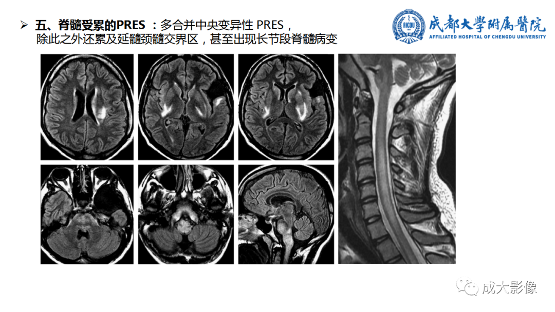 影像PPT - 【PPT】可逆性后部脑病综合征-20