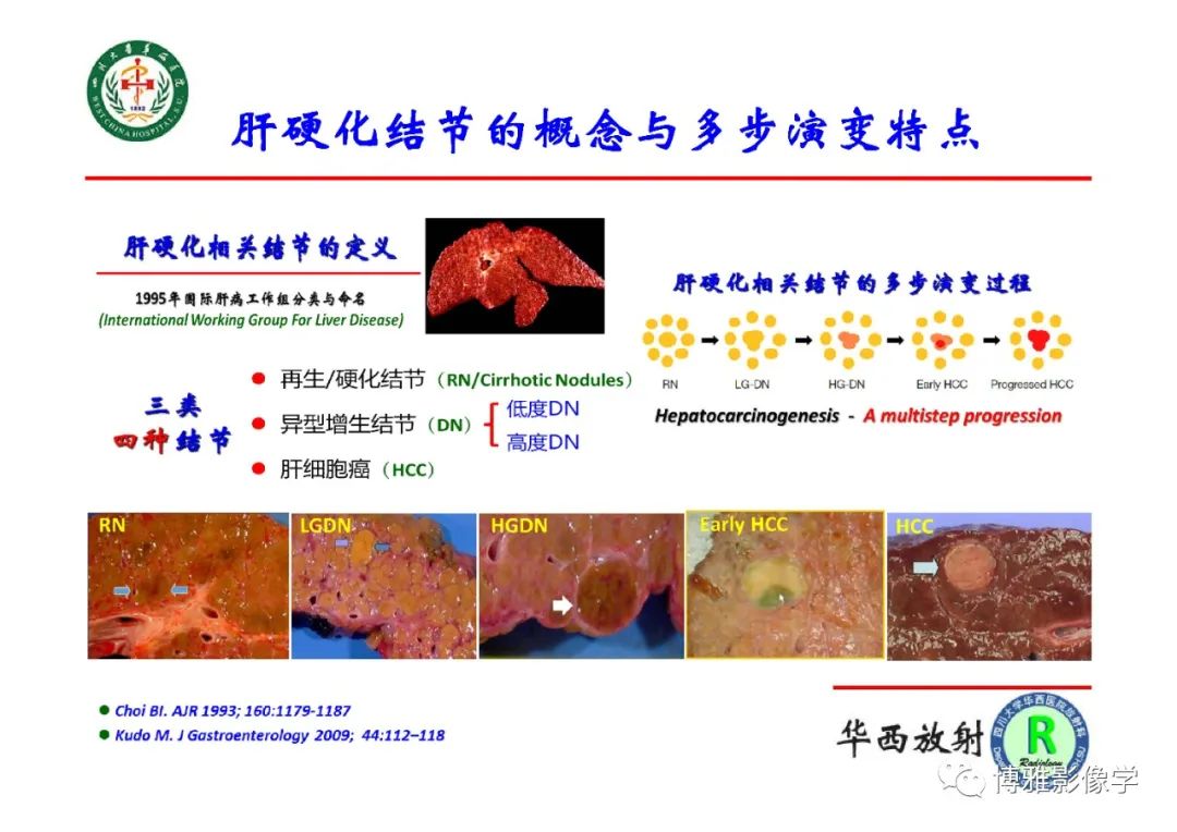 影像PPT - 【PPT】肝硬化结节多步癌变的影像学评价-3