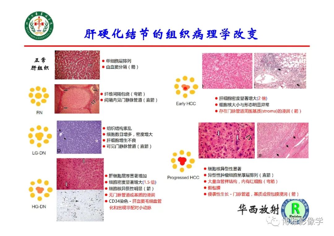 影像PPT - 【PPT】肝硬化结节多步癌变的影像学评价-4