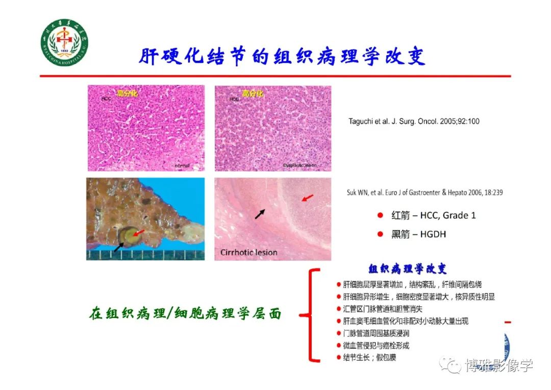 影像PPT - 【PPT】肝硬化结节多步癌变的影像学评价-5
