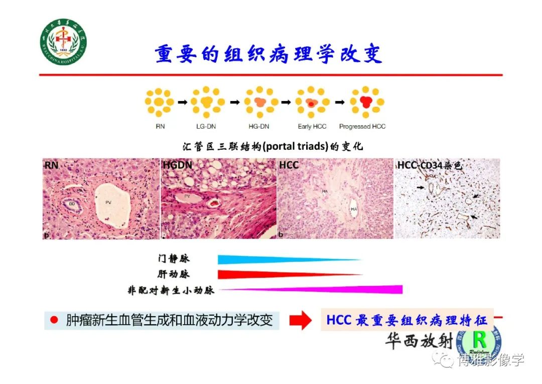 影像PPT - 【PPT】肝硬化结节多步癌变的影像学评价-6