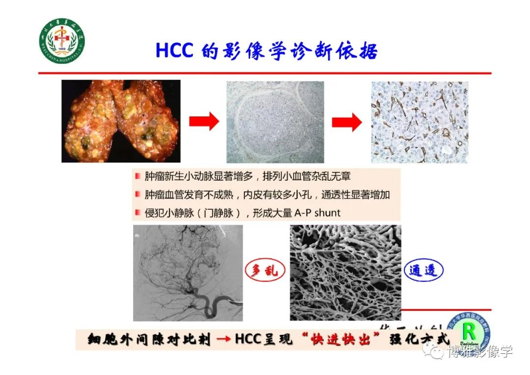 影像PPT - 【PPT】肝硬化结节多步癌变的影像学评价-7
