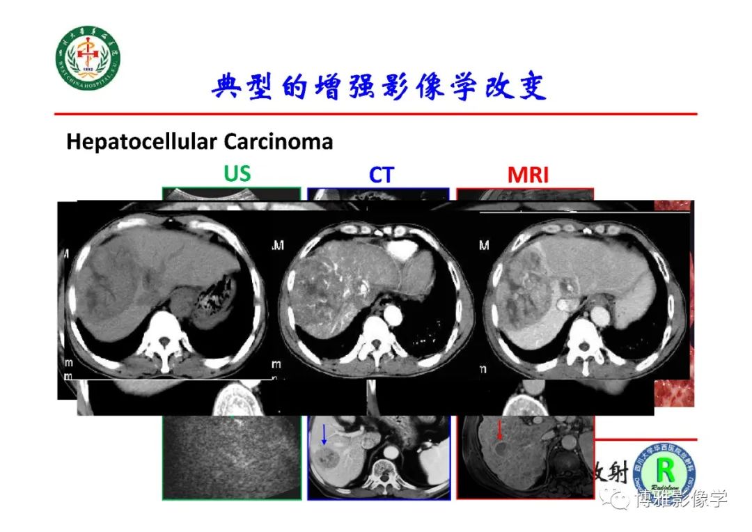 影像PPT - 【PPT】肝硬化结节多步癌变的影像学评价-8