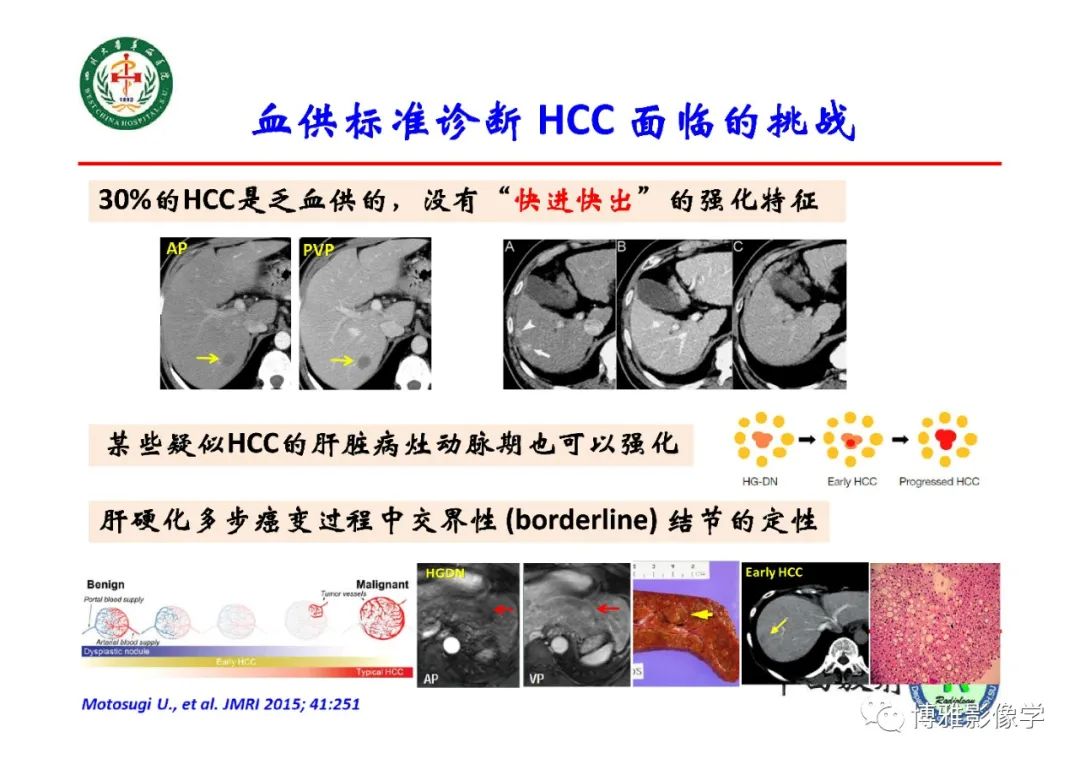 影像PPT - 【PPT】肝硬化结节多步癌变的影像学评价-10