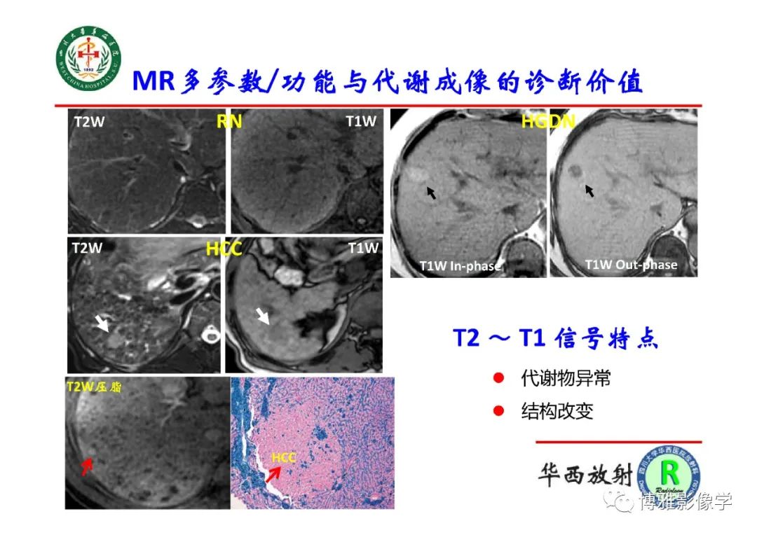 影像PPT - 【PPT】肝硬化结节多步癌变的影像学评价-15