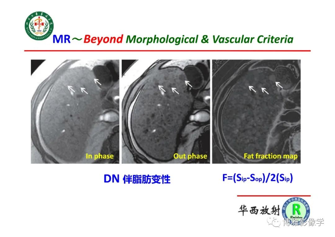 影像PPT - 【PPT】肝硬化结节多步癌变的影像学评价-17